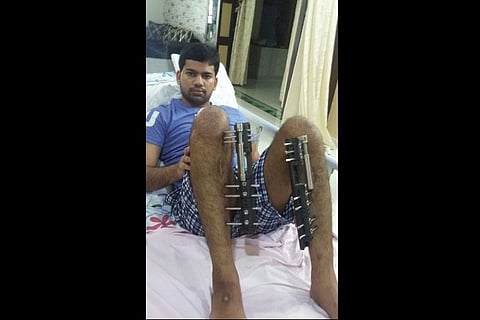 Months after 'height-lengthening' surgery, Hyderabad techie remains bed-ridden