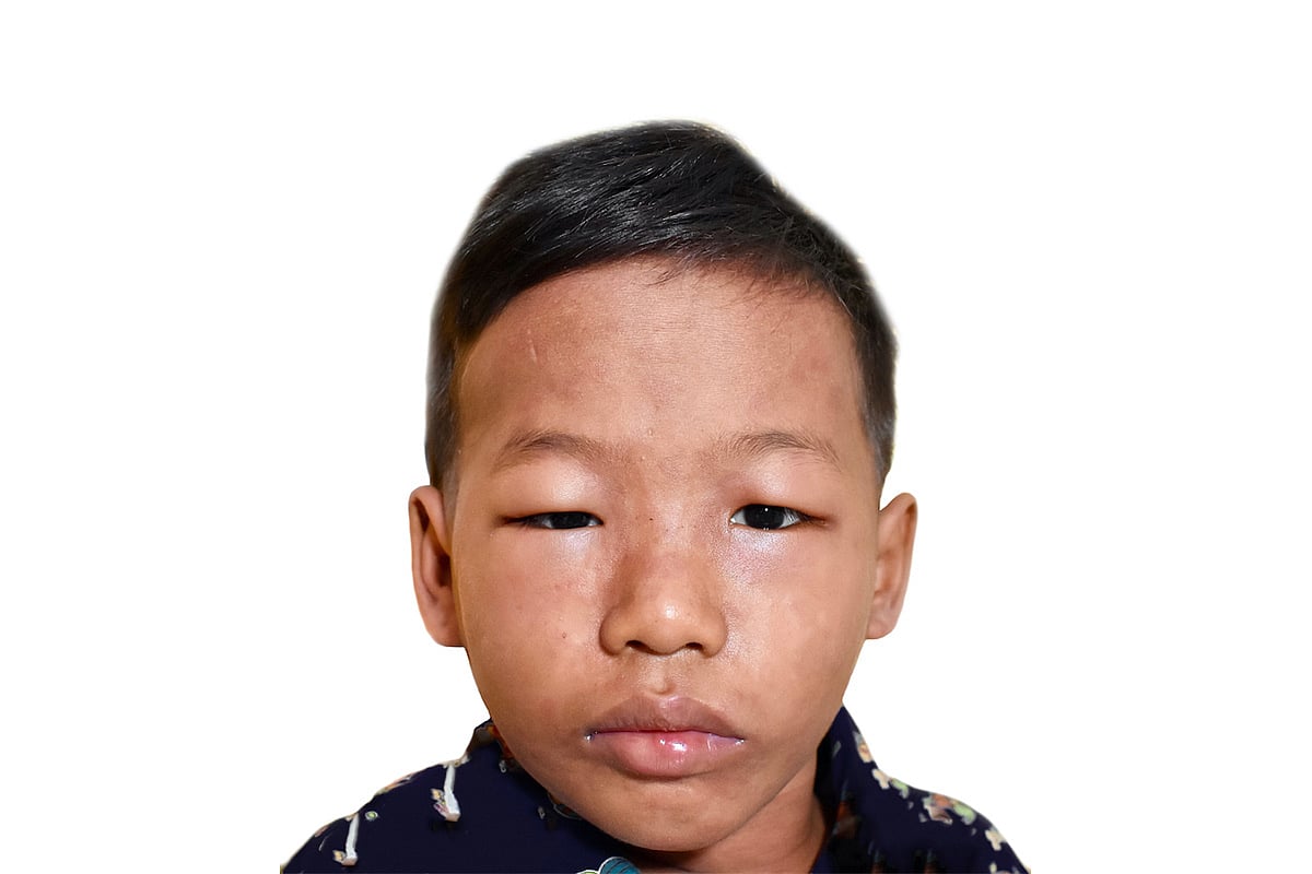 Don’t ignore swollen eyelids, it could be nephrotic syndrome