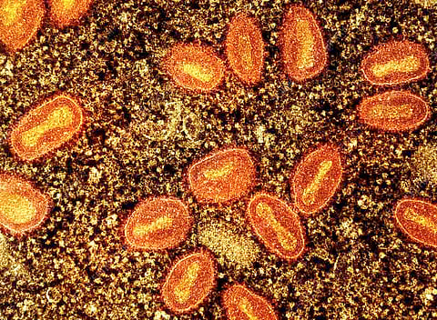 Bilang ng may mpox 5 na; bata, babae nahawaan 