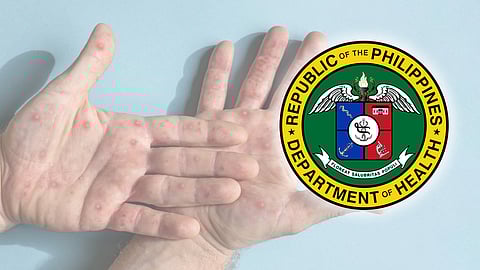 Mpox ‘easier’ to contain even without vaccines, says DoH