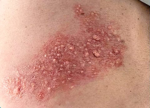 Shingles rashes