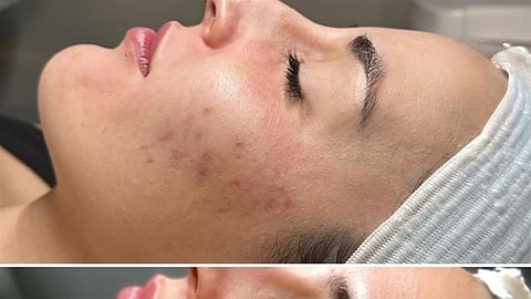 The treatment starts with a lympathic massage to help the patient relax.