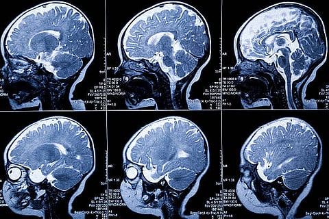 World Brain Day raises neurological health awareness