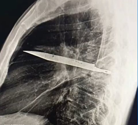 Doctors discover knife blade in man’s chest after 8 years