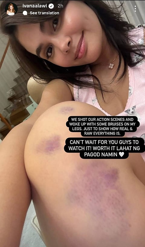 Ivana Alawi proudly shares her battle scars