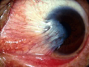 
PTERYGIUM, most commonly known as ‘pugita sa mata,’ is a triangular, fleshy, fibrovascular sheet originating from the conjunctiva and extending to the corneal limbus and beyond. 