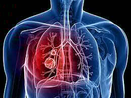 Lung cancer toll rises as detection lags