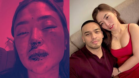 Right: DJ and social media influencer Jellie Aw and Jam Ignacio together, smiling for the camera. 

Left: A photo Aw posted earlier this year showing her bruised and bloodied face following the alleged assault by Ignacio.