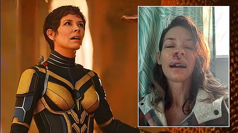 Evangeline Lilly shares a photo of her facial injuries following a May 2025 accident in which she fainted at a beach and fell face-first into a boulder, resulting in a concussion and traumatic brain injury.