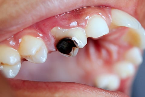 WHO guidelines recommend mercury-free restorations. 