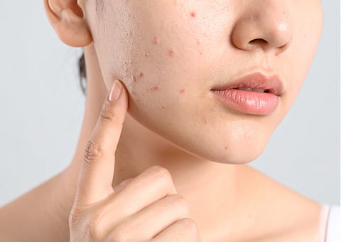 COMMON sun-related skin conditions include sunburn, acne and fungal infection.