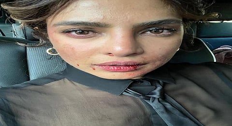 Priyanka Chopra shares picture of 'bruised' face from 'Citadel' set