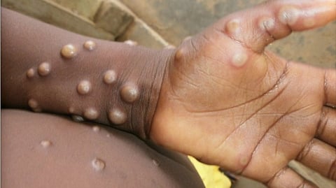 Belarus develops test systems for monkeypox detection
