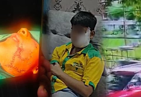 Ghaziabad: Pitbull mauls 11-year-old playing in Park in gruesome viral CCTV footage; received over 150 stitches