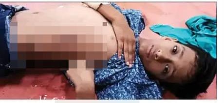 Mohali: Child gets electric shock; Deep wounds in the stomach, Family alleges- PSPCL is asking for money to set the wires