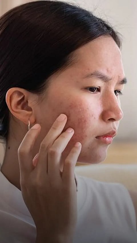 Easily Available Food To Fight Acne