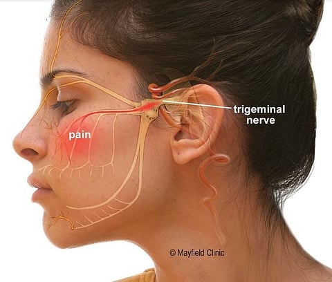 Finding Sweet Relief for Searing Face Pain