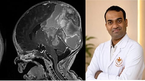 ಎಂಐಆರ್​ ಸ್ಕ್ಯಾನಿಂಗ್​ನಲ್ಲಿ ಗೋಚರಿಸಿದ ಮಗುವಿನ ತಲೆಯಲ್ಲಿದ್ದ ದೊಡ್ಡ ಗಡ್ಡೆ. ಯಶಸ್ವಿ ಶಸ್ತ್ರಚಿಕಿತ್ಸೆ ನಡೆಸಿದ್ದ ಉಡುಪಿ ಮಣಿಪಾಲದ ಕೆಎಂಸಿ ನರಶಸ್ತ್ರ ಚಿಕಿತ್ಸಾ ವಿಭಾಗದ ಮುಖ್ಯಸ್ಥ ಡಾ. ರಾಘವೇಂದ್ರ ನಾಯಕ್​.