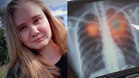 Pneumonic Plague 