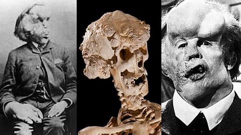 Joseph Carey Merrick