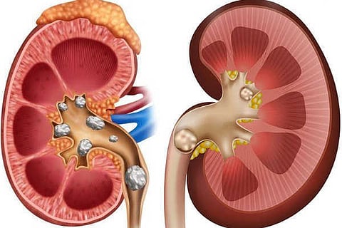 Kidney vvani