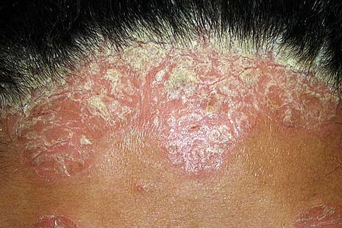 psoriasis