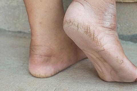 cracked-heels