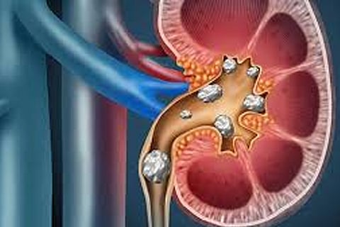Kidney Stone
