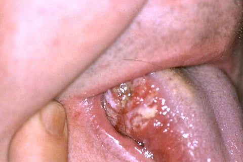 mouth cancer
