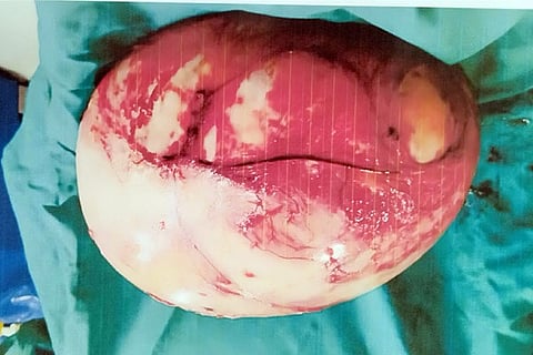 07032020 raichur Musines Systadinoma Appendix