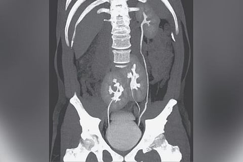 kidney