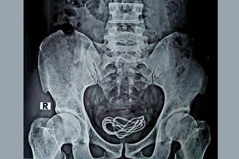 urethral sounding