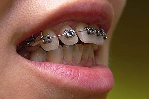 Curved teeth