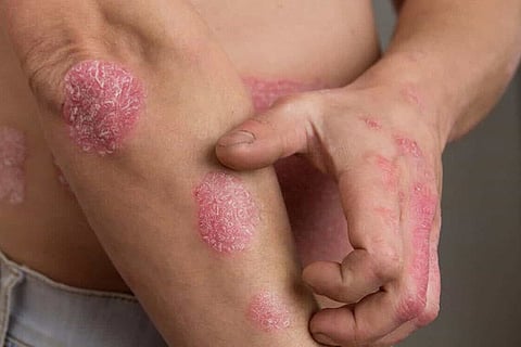 Psoriasis