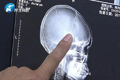 Skull
