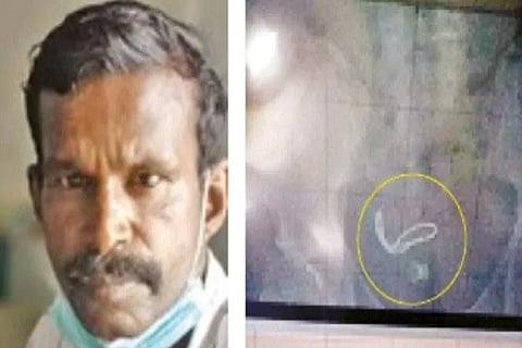 A man swallowed a stolen ornament
