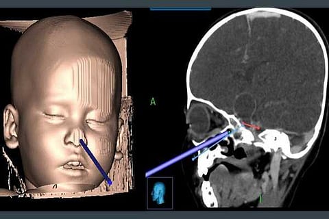 Tumor