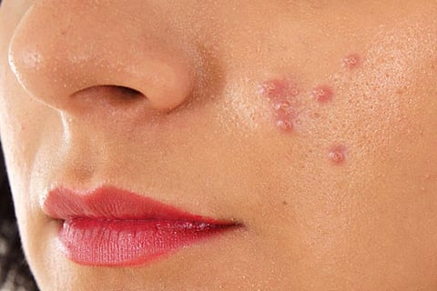 face acne