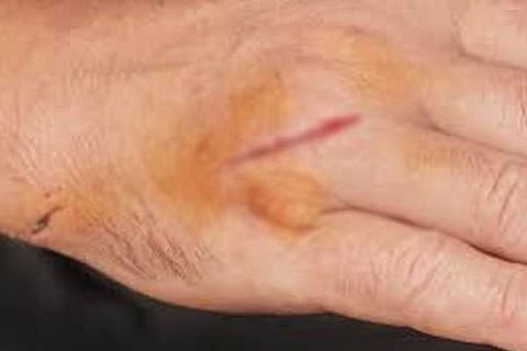 wound
