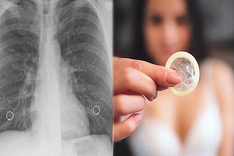 Woman Condom