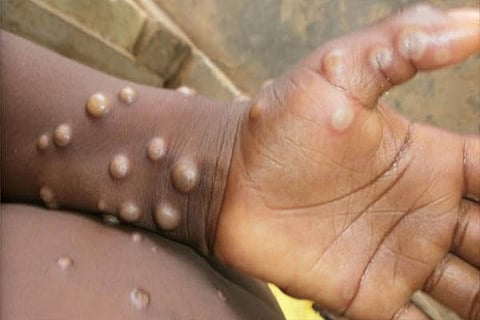 monkeypox