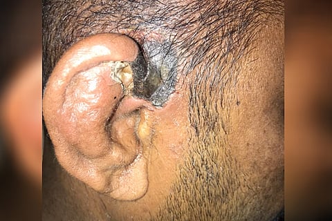 skin fungus