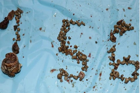 Kidney Stones