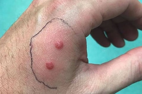 snake bite