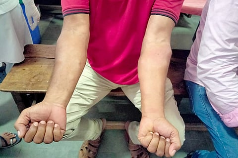 honey bee bite