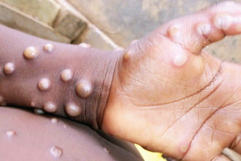 Monkey Pox