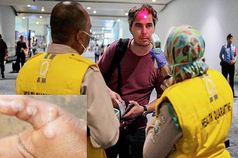 Monkeypox virus