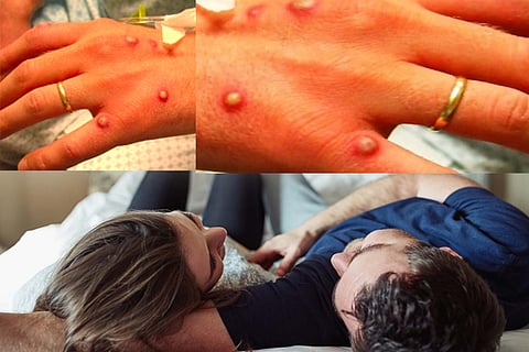 monkeypox