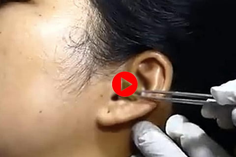 Snake in Ear