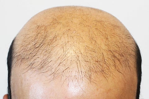Hair Transplant